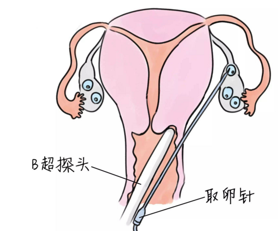 试管婴儿移植